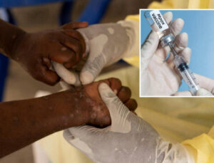 ABD gönderdi: Nijerya’ya 10 bin doz M çiçeği aşısı