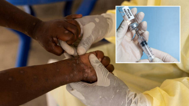 ABD gönderdi: Nijerya’ya 10 bin doz M çiçeği aşısı