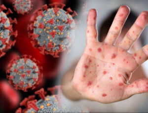 Afrika Birliği: M çiçeği salgını yalnızca Afrika’nın değil tüm dünyanın sorunu