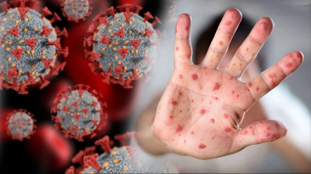 Afrika Birliği: M çiçeği salgını yalnızca Afrika’nın değil tüm dünyanın sorunu