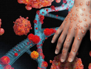 M çiçeği virüsü yayılıyor: Bir ülkeye daha sıçradı