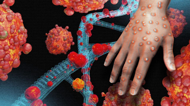 M çiçeği virüsü yayılıyor: Bir ülkeye daha sıçradı