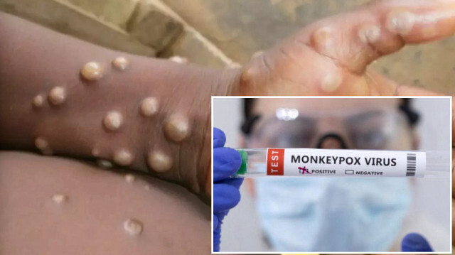 Maymun Çiçeği Türkiye’de görüldü mü? Bakan Memişoğlu ‘alarmdayız’ diyerek canlı yayında açıkladı