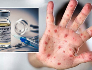 Maymun çiçeği aşısına onay verildi: Maymun çiçeği aşısı nasıl uygulanacak? Kaç doz olacak?