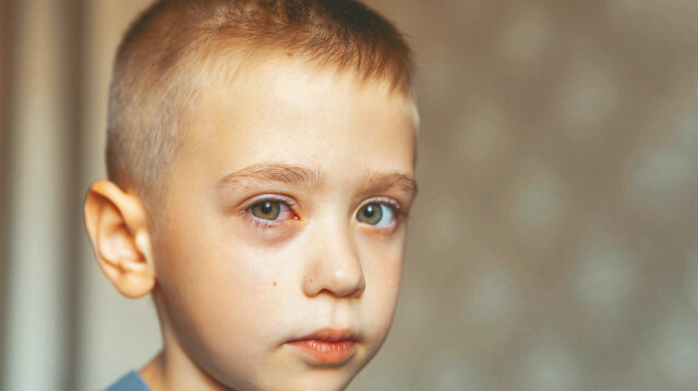 ‘Kırmızı gözler’e dikkat