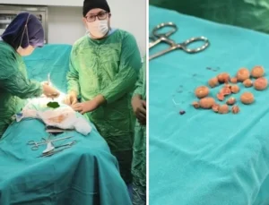 İki hastanın mesanesinden 27 taş çıkarıldı