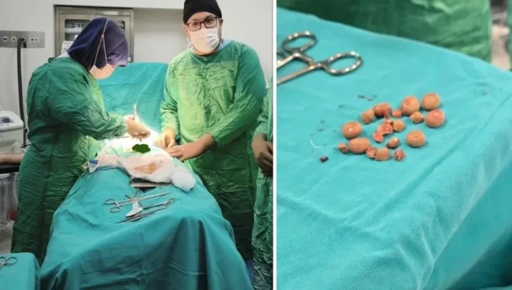 İki hastanın mesanesinden 27 taş çıkarıldı